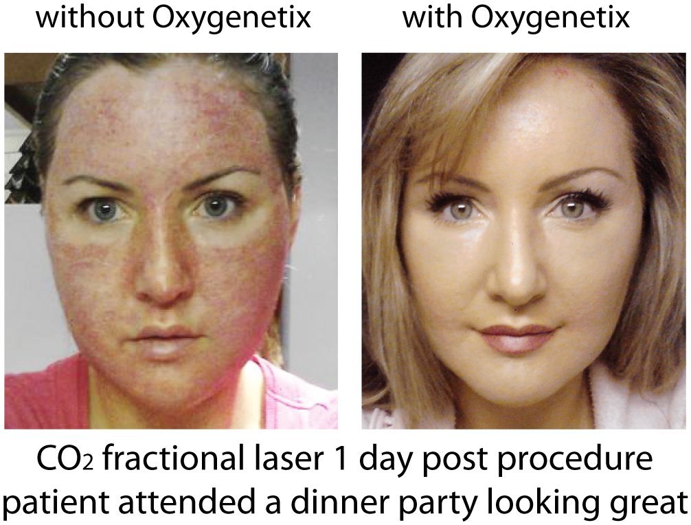 Oxygenetix2