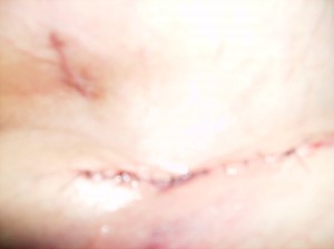 melanoma3